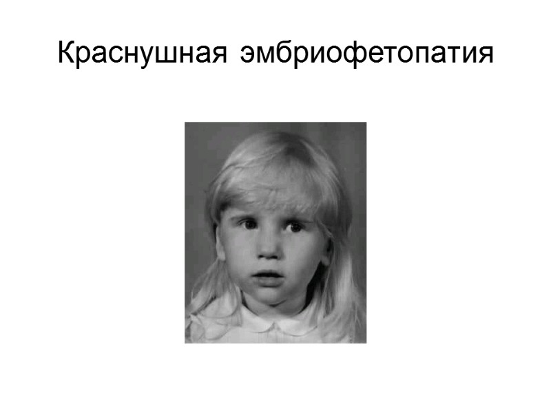 Краснушная эмбриофетопатия